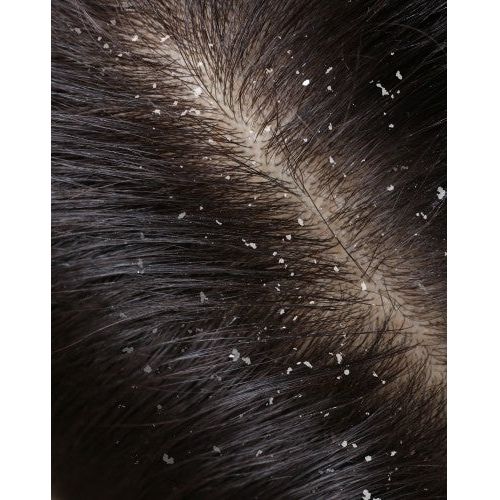 Hair Care Gift Set For Irritated Scalp